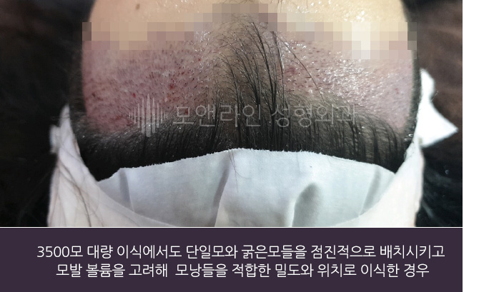 3500모 대량 이식에서도 단일모와 굵은모들을 점진적으로 배치시키고 모발 볼륨을 고려해 모낭들을 적합한 밀도와 위치로 이식한 경우