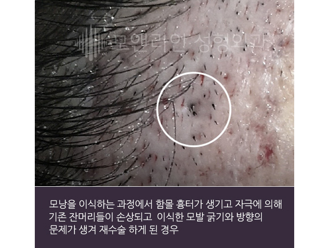 모낭을 이식하는 과정에서 함몰 흉터가 생기고 자극에 의해 기존 잔머리들이 손상되고 이식한 모발 굵기와 방향의 문제가 생겨 재수술 하게 된 경우