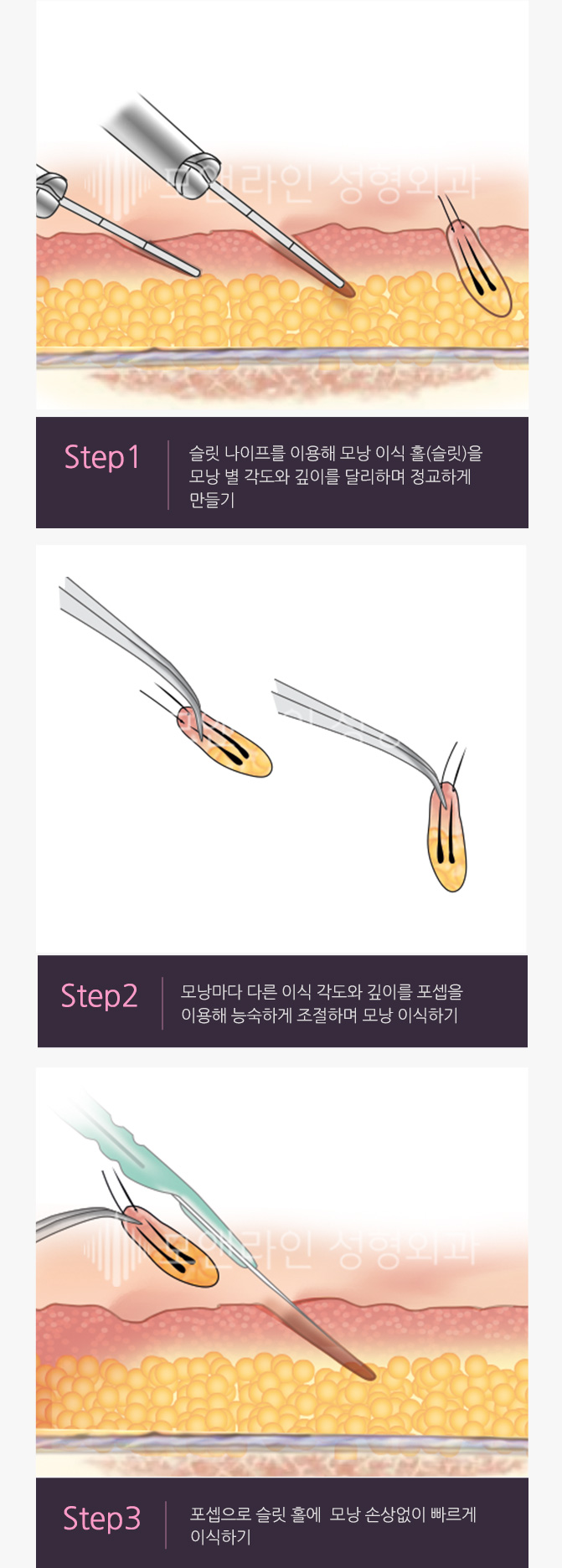 Step1. 슬릿 나이프를 이용해 모낭 이식 홀(슬릿)을 모낭 별 각도와 깊이를 달리하며 정교하게 만들기 > Step2. 모낭마다 다른 이식 각도와 깊이를 포셉을 이용해 능숙하게 조절하며 모낭 이식하기 > Step3. 포셉으로 슬릿 홀에  모낭 손상없이 빠르게 이식하기