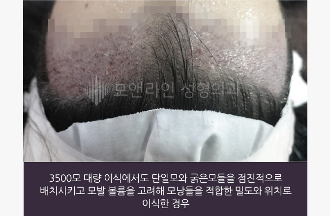 3500모 대량 이식에서도 단일모와 굵은모들을 점진적으로 배치시키고 모발 볼륨을 고려해 모낭들을 적합한 밀도와 위치로 이식한 경우