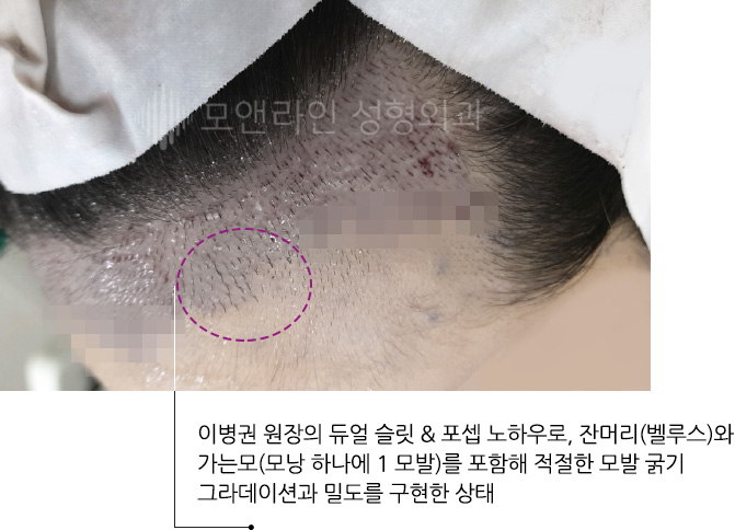 이병권 원장의 듀얼 슬릿 & 포셉 노하우로, 잔머리(벨루스)와 가는모(모낭 하나에 1 모발)를 포함해 적절한 모발 굵기 그라데이션과 밀도를 구현한 상태