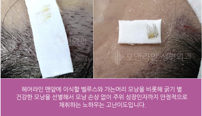 헤어라인 맨앞에 이식할 벨루스와 가는머리 모낭을 비롯해 굵기 별 건강한 모낭을 선별해서 모낭 손상 없이 주위 성장인자까지 안정적으로 채취하는 노하우는 고난이도입니다.