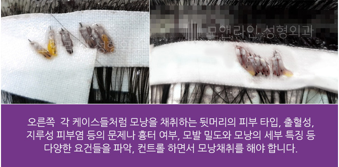 오른쪽  각 케이스들처럼 모낭을 채취하는 뒷머리의 피부 타입, 출혈성, 지루성 피부염 등의 문제나 흉터 여부, 모발 밀도와 모낭의 세부 특징 등 다양한 요건들을 파악, 컨트롤 하면서 모낭채취를 해야 합니다.