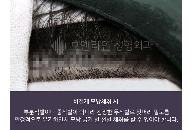 비절개 모낭채취 시 부분삭발이나 줄삭발이 아니라 진정한 무삭발로 뒷머리 밀도를 안정적으로 유지하면서 모낭 굵기 별 선별 채취를 할 수 있어야 합니다.