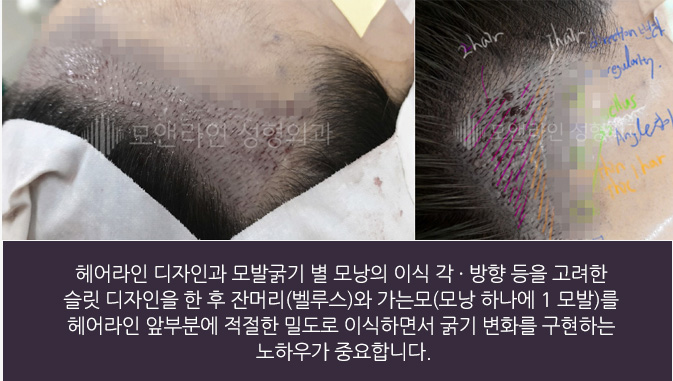 헤어라인 디자인과 모발굵기 별 모낭의 이식 각 · 방향 등을 고려한 슬릿 디자인을 한 후 잔머리(벨루스)와 가는모(모낭 하나에 1 모발)를 헤어라인 앞부분에 적절한 밀도로 이식하면서 굵기 변화를 구현하는 노하우가 중요합니다.