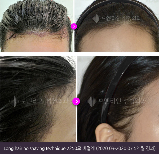 Long hair no shaving technique 2250모 비절개(2020.03-2020.07 5개월 경과)