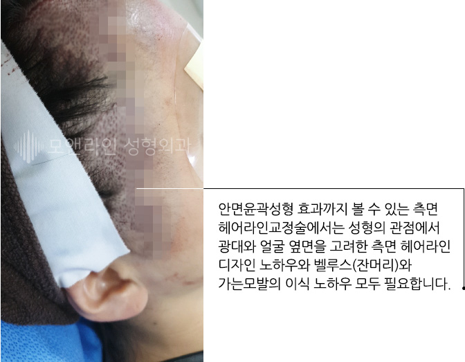 안면윤곽성형 효과까지 볼 수 있는 측면 헤어라인교정술에서는 성형의 관점에서 광대와 얼굴 옆면을 고려한 측면 헤어라인 디자인 노하우와 벨루스(잔머리)와 가는모발의 이식 노하우 모두 필요합니다.