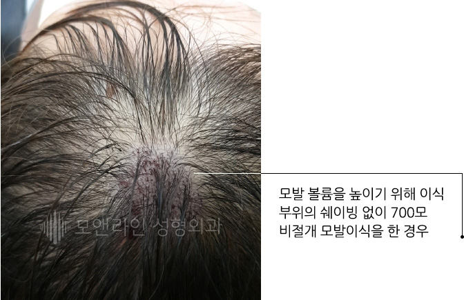 모발 볼륨을 높이기 위해 이식 부위의 쉐이빙 없이 700모 비절개 모발이식을 한 경우