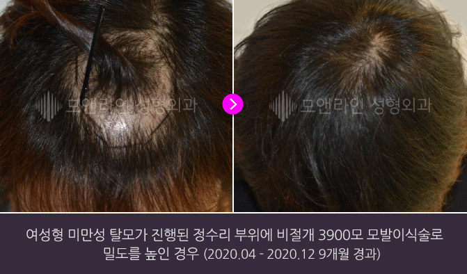 여성형 미만성 탈모가 진행된 정수리 부위에 비절개 3900모 모발이식술로 밀도를 높인 경우(2020.04 - 2020.12 9개월 경과)