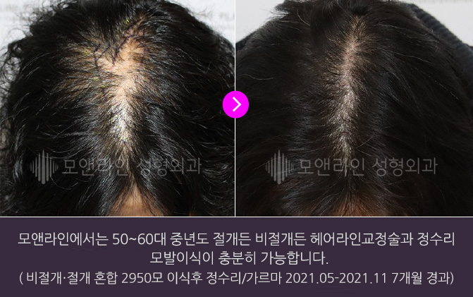 모앤라인에서는 50~60대 중년도 절개든 비절개든 헤어라인교정술과 정수리 모발이식이 충분히 가능합니다.(절개 모낭채취로 2750모 이식 후. 정수리/가르마 2021.05-2021.11 7개월 경과)