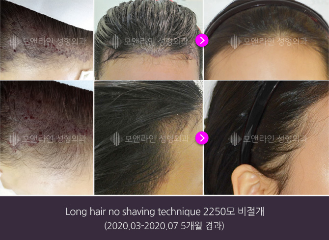 Long hair no shaving technique 2250모 비절개(2020.03-2020.07 5개월 경과)