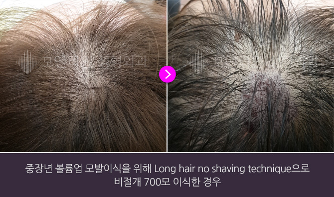 중장년 볼륨업 모발이식을 위해 Long hair no shaving technique으로 비절개 700모 이식한 경우