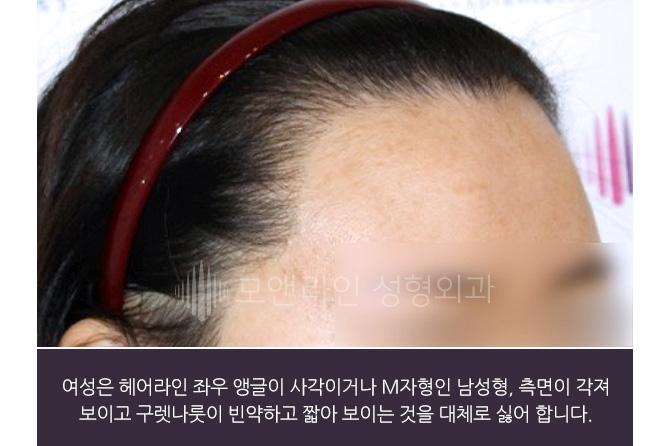 여성은 헤어라인 좌우 앵글이 사각이거나 M자형인 남성형, 측면이 각져 보이고 구레나룻이 빈약하고 짧아 보이는 것을 대체로 싫어합니다.