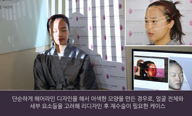 단순하게 헤어라인 디자인을 해서 어색한 모양을 만든 경우로, 얼굴 전체와 세부 요소들을 고려해 리디자인 후 재수술이 필요한 케이스