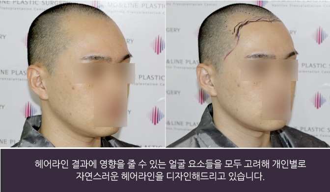 헤어라인 결과에 영향을 줄 수 있는 얼굴 요소들을 모두 고려해 개인별로 자연스러운 헤어라인을 디자인해드리고 있습니다.