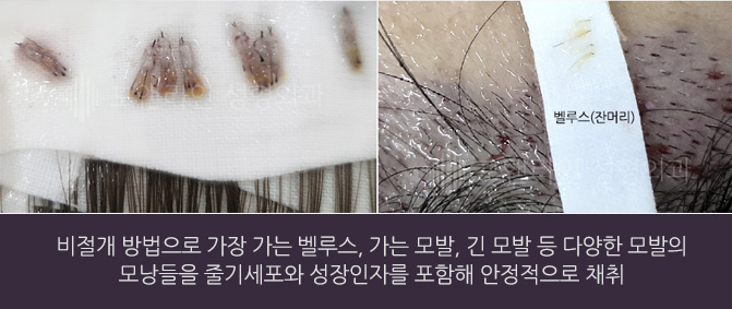 비절개 방법으로 가장 가는 벨루스, 가는 모발, 긴 모발 등 다양한 모발의 모낭들을 줄기세포와 성장인자를 포함해 안정적으로 채취