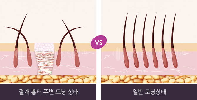 절개 흉터 주변 모낭 상태 VS 일반 모낭상태