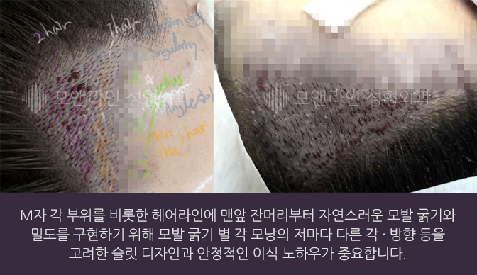 M자 각 부위를 비롯한 헤어라인에 맨앞 잔머리부터 자연스러운 모발 굵기와 밀도를 구현하기 위해 모발 굵기 별 각 모낭의 저마다 다른 각 · 방향 등을 고려한 슬릿 디자인과 안정적인 이식 노하우가 중요합니다.