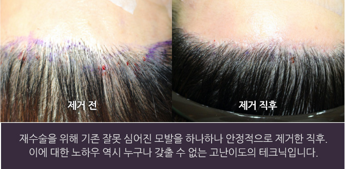 재수술을 위해 기존 잘못 심어진 모발을 하나하나 안정적으로 제거한 직후. 이에 대한 노하우 역시 누구나 갖출 수 없는 고난이도의 테크닉입니다.