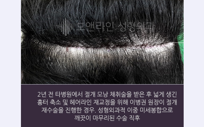 2년 전 타병원에서 절개 모낭 채취술을 받은 후 넓게 생긴 흉터 축소 및 헤어라인 재교정을 위해 이병권 원장이 절개 재수술을 진행한 경우. 성형외과적 이중 미세봉합으로 깨끗이 마무리된 수술 직후