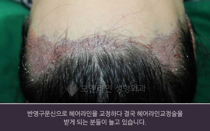 반영구문신으로 헤어라인을 교정하다 결국 헤어라인교정술을 받게 되는 분들이 늘고 있습니다.