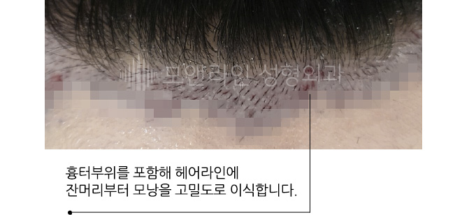 흉터부위를 포함해 헤어라인에 잔머리부터 모낭을 고밀도로 이식합니다.