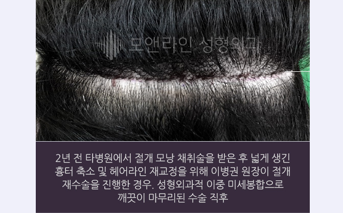 2년 전 타병원에서 절개 모낭 채취술을 받은 후 넓게 생긴 흉터 축소 및 헤어라인 재교정을 위해 이병권 원장이 절개 재수술을 진행한 경우. 성형외과적 이중 미세봉합으로 깨끗이 마무리된 수술 직후