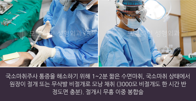 국소마취주사 통증을 해소하기 위해 1~2분 짦은 수면마취, 국소마취 상태에서 원장이 절개 또는 무삭발 비절개로 모낭 채취(3000모 비절개도 한 시간 반 정도면 충분). 절개시 무흉 이중 봉합술