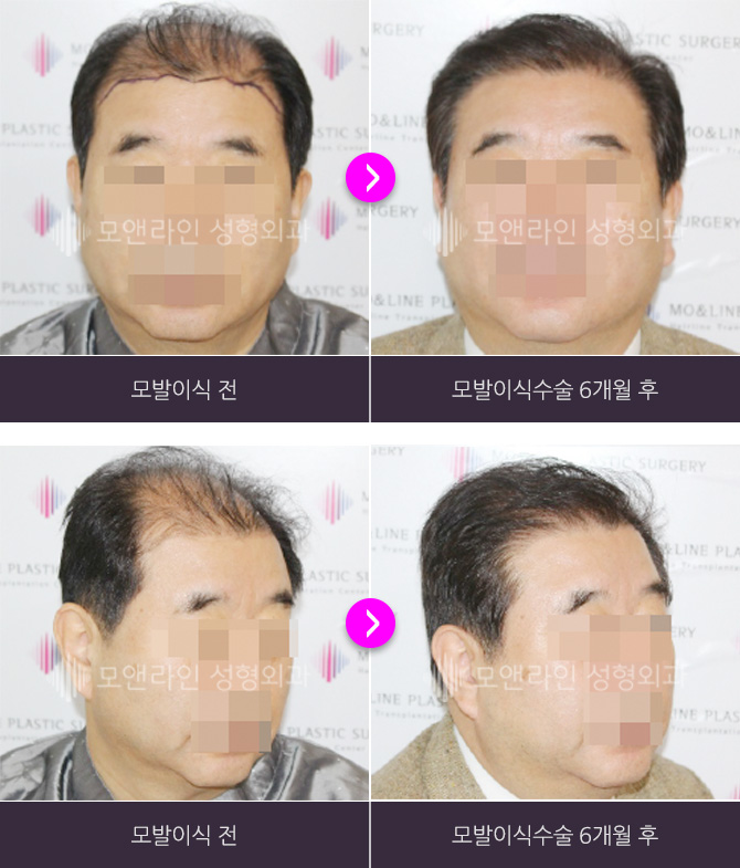 정면 사진 : 모발이식 전 > 모발이식수술 6개월 후 / 측면 사진 : 모발이식 전 > 모발이식수술 6개월 후