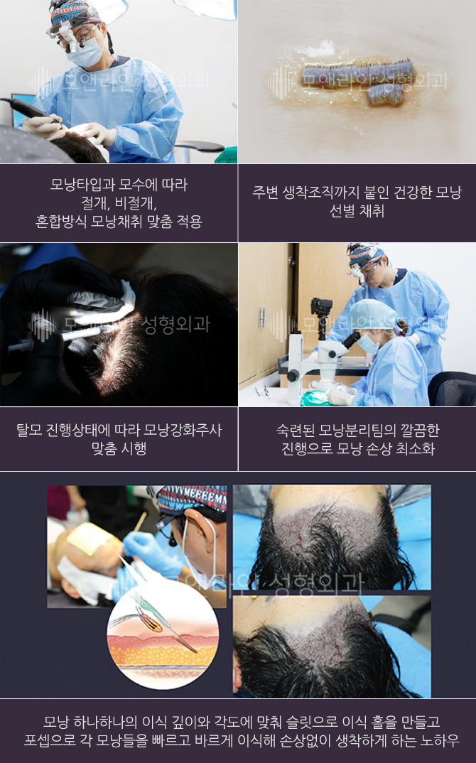 모낭타입과 모수에 따라 절개, 비절개, 혼합방식 모낭채취 맞춤 적용 / 주변 생착조직까지 붙인 건강한 모낭 선별 채취 / 탈모 진행상태에 따라 모낭강화주사 맞춤 시행 / 숙련된 모낭분리팀의 깔끔한 진행으로 모낭 손상 최소화 / 모낭 하나하나의 이식 깊이와 각도에 맞춰 슬릿으로 이식 홀을 만들고 포셉으로 각 모낭들을 빠르고 바르게 이식해 손상없이 생착하게 하는 노하우