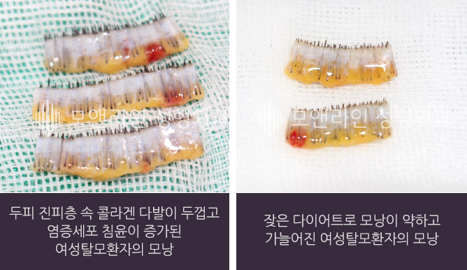 좌측 사진 : 두피 진피층 속 콜라겐 다발이 두껍고 염증세포 침윤이 증가된 여성탈모환자의 모낭 / 우측 사진 : 잦은 다이어트로 모낭이 약하고 가늘어진 여성탈모환자의 모낭