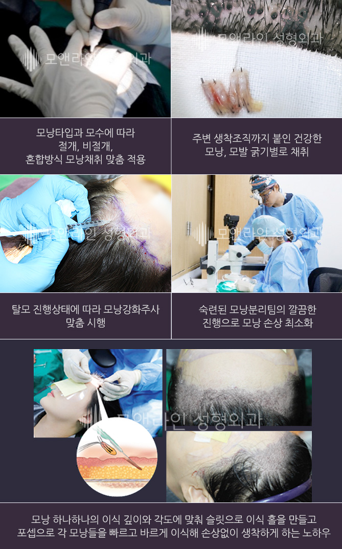 모낭타입과 모수에 따라 절개, 비절개, 혼합방식 모낭채취 맞춤 적용 / 주변 생착조직까지 붙인 건강한 모낭 선별 채취 / 탈모 진행상태에 따라 모낭강화주사 맞춤 시행 / 숙련된 모낭분리팀의 깔끔한 진행으로 모낭 손상 최소화 / 모낭 하나하나의 이식 깊이와 각도에 맞춰 슬릿으로 이식 홀을 만들고 포셉으로 각 모낭들을 빠르고 바르게 이식해 손상없이 생착하게 하는 노하우