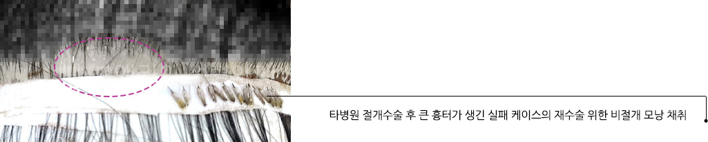 타병원 절개수술 후 큰 흉터가 생긴 실패 케이스의 재수술 위한 비절개 모낭 채취