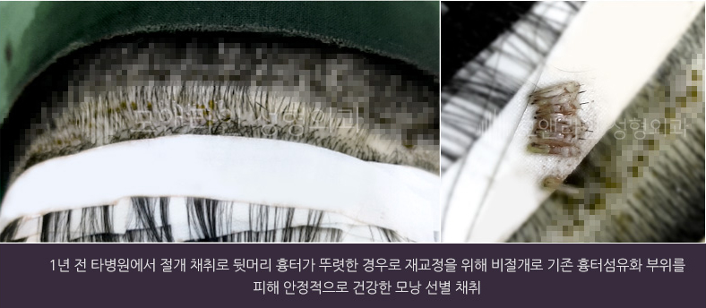 1년 전 타병원에서 절개 채취로 뒷머리 흉터가 뚜렷한 경우로 재교정을 위해 비절개로 기존 흉터섬유화 부위를 피해 안정적으로 건강한 모낭 선별 채취