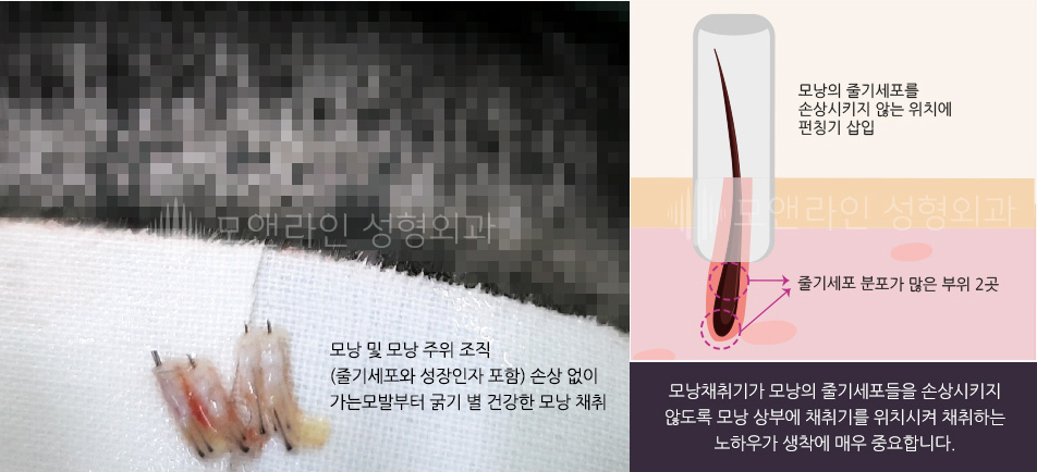 모낭채취기가 모낭의 줄기세포들을 손상시키지 않도록 모낭 상부에 채취기를 위치시켜 채취하는 노하우가 생착에 매우 중요합니다.
