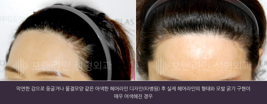 막연한 감으로 둥글거나 물결모양 같은 어색한 헤어라인 디자인(타병원) 후 실제 헤어라인의 형태와 모발 굵기 구현이 매우 어색해진 경우