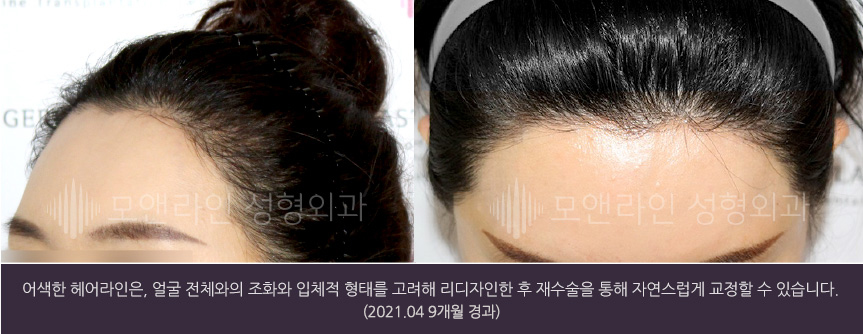 어색한 헤어라인은, 얼굴 전체와의 조화와 입체적 형태를 고려해 리디자인한 후 재수술을 통해 자연스럽게 교정할 수 있습니다.(2021.04 9개월 경과)