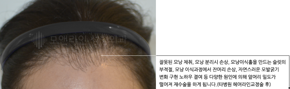 잘못된 모낭 채취, 모낭 분리시 손상, 모낭이식홀을 만드는 슬릿의 부적절, 모낭 이식과정에서 잔머리 손상, 자연스러운 모발굵기 변화 구현 노하우 결여 등 다양한 원인에 의해 앞머리 밀도가 떨어져 재수술을 하게 됩니다.(타병원 헤어라인교정술 후)