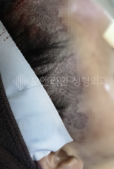 이마축소성형술 후 헤어라인 흉터, 여전히 높고 어색한 모양의 이마 때문에 헤어라인교정술을 받았으나 이마 높이와 헤어라인 형태의 개선이 잘되지 못한 경우