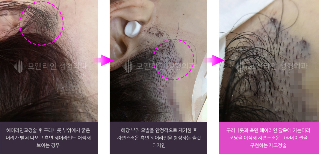 헤어라인교정술 후 구레나룻 부위에서 굵은 머리가 뻗쳐 나오고 측면 헤어라인도 어색해 보이는 경우 > 해당 부위 모발을 안정적으로 제거한 후 자연스러운 측면 헤어라인을 형성하는 슬릿 디자인 > 구레나룻과 측면 헤어라인 앞쪽에 가는머리 모낭을 이식해 자연스러운 그라데이션을 구현하는 재교정술