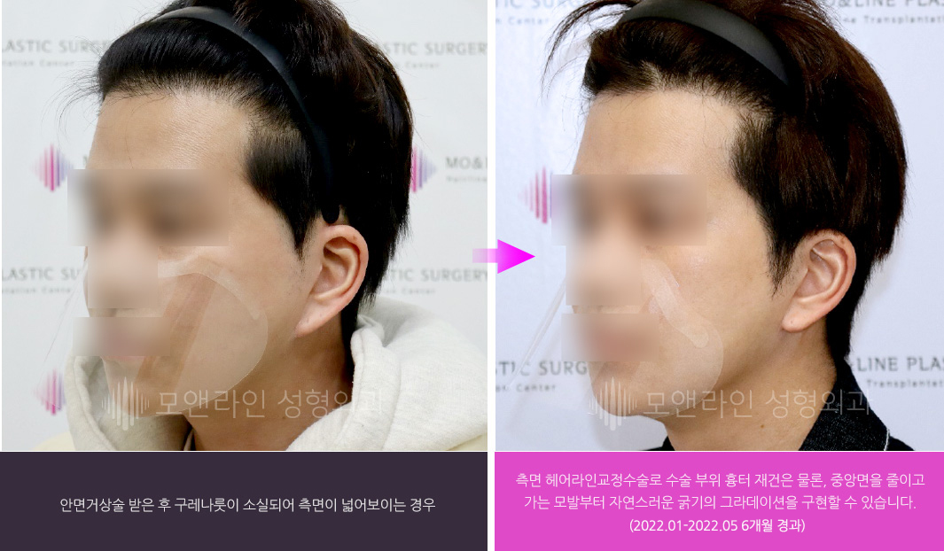 넓은 얼굴 축소를 위해 안면윤곽수술을 받았으나 중안부가 여전히 넓고 수술 흉터가 두드러지고 측면 잔머리가 소실되어 더 넓어 보이는 경우 > 수술부위 흉터 재건은 물론, 측면 헤어라인교정수술로 넓은 중앙면을 줄이고 가는머리부터 자연스러운 그라데이션이 구현된 측면 헤어라인을 만들 수 있습니다.(2022.01-2022.05 6개월 경과)
