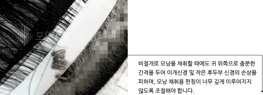 이마축소성형술 후 헤어라인 흉터, 여전히 높고 어색한 모양의 이마 때문에 헤어라인교정술을 받았으나 이마 높이와 헤어라인 형태의 개선이 잘되지 못한 경우