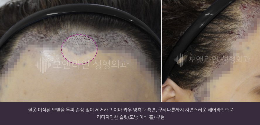 잘못 이식된 모발을 두피 손상 없이 제거하고 이마 좌우 양측과 측면, 구레나룻까지 자연스러운 헤어라인으로 리디자인한 슬릿(모낭 이식 홀) 구현