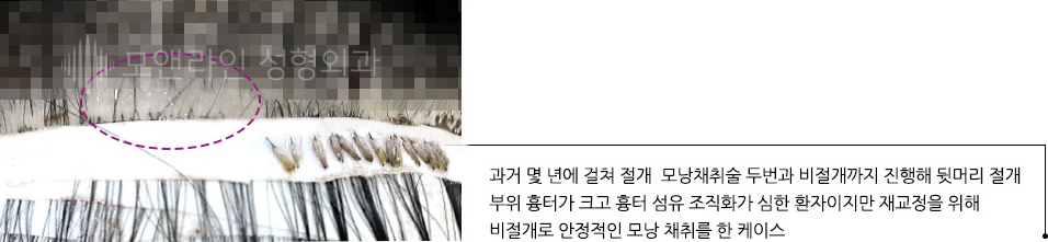 과거 몇 년에 걸쳐 절개  모낭채취술 두번과 비절개까지 진행해 뒷머리 절개 부위 흉터가 크고 흉터 섬유 조직화가 심한 환자이지만 재교정을 위해 비절개로 안정적인 모낭 채취를 한 케이스