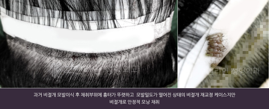 과거 비절개 모발이식 후 채취부위에 흉터가 뚜렷하고 모발밀도가 떨어진 상태의 비절개 재교정 케이스지만 비절개로 안정적 모낭 채취