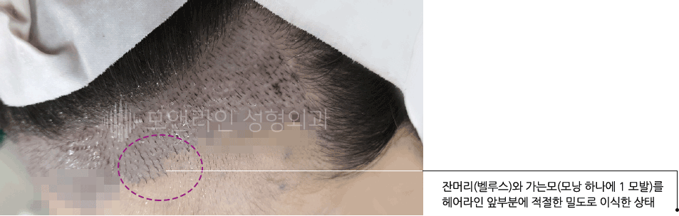 잔머리(벨루스)와 가는모(모낭 하나에 1 모발)를 헤어라인 앞부분에 적절한 밀도로 이식한 상태