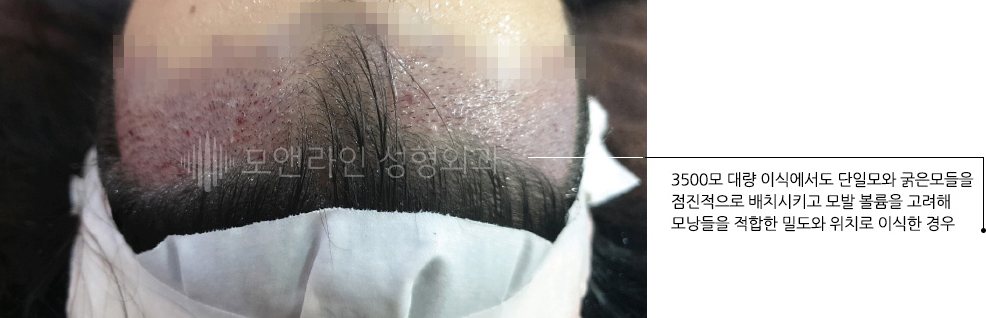 3500모 대량 이식에서도 단일모와 굵은모들을 점진적으로 배치시키고 모발 볼륨을 고려해 모낭들을 적합한 밀도와 위치로 이식한 경우