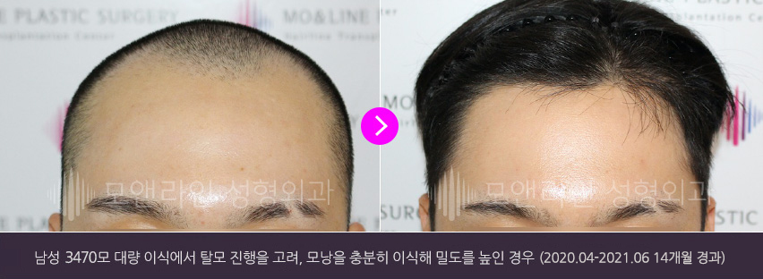 남성 3300모 대량 이식에서 탈모 진행을 고려, 모낭을 충분히 이식해 밀도를 높인 경우(2020.04-2021.06 14개월 경과)