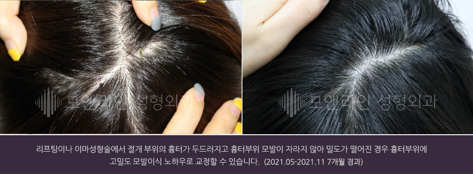 리프팅이나 이마성형술에서 절개 부위의 흉터가 두드러지고 흉터부위 모발이 자라지 않아 밀도가 떨어진 경우 흉터부위 고밀도 모발이식 노하우로 교정할 수 있습니다.(2021.05-2021.11 7개월 경과)