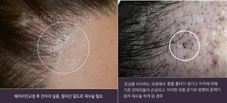 헤어라인교정 후 잔머리 실종, 떨어진 밀도로 재수술 필요 / 모낭을 이식하는 과정에서 함몰 흉터가 생기고 자극에 의해 기존 잔머리들이 손상되고 이식한 모발 굵기와 방향의 문제가 생겨 재수술 하게 된 경우